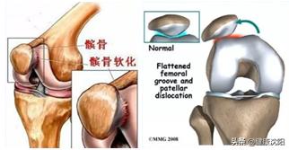 老年人髌骨软化症的最佳锻炼方法,健康科普堂骨折后该如何急救