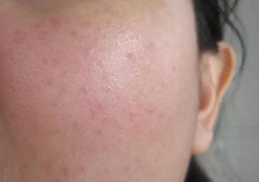 微整形美白针,微整形是永久的吗