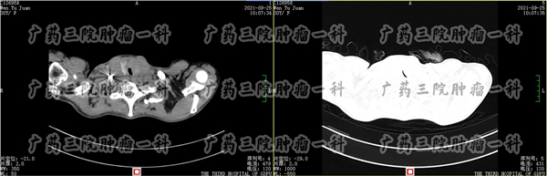 中山一院治疗甲状腺癌最好的医生,广州肿瘤医院治疗甲状腺癌怎么样