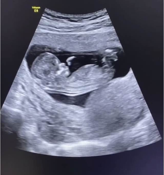 孕检医生说胎儿懒出生后会懒惰吗,产检医生说胎儿偏小怎么办