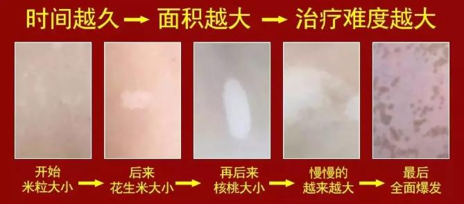 白癜风不扩散了能停止治疗吗,白癜风不再扩散要不要治疗
