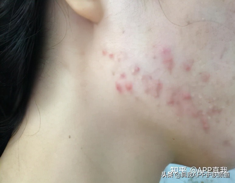 敏感肌肤满脸闭口可以刷酸吗,脸上好多闭口粉刺很敏感怎么办