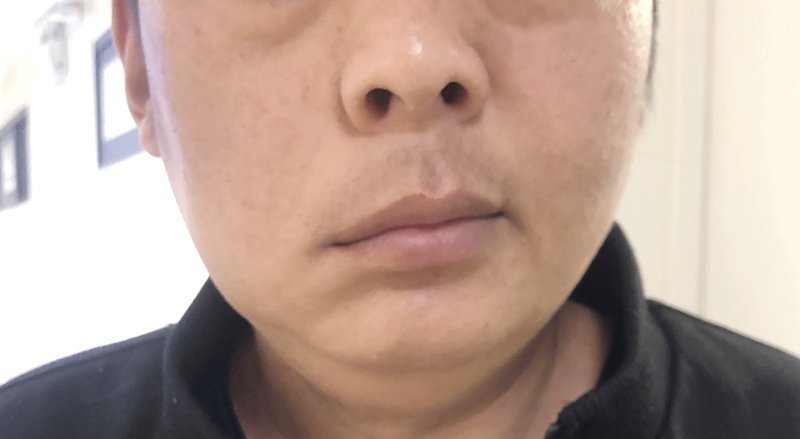 左边面肌痉挛会引起右眼皮跳动,面肌痉挛眼皮抽搐的自愈方法