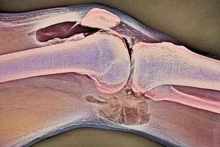 骨破坏怎么治疗最好,类风湿引起的骨侵蚀还能修复吗