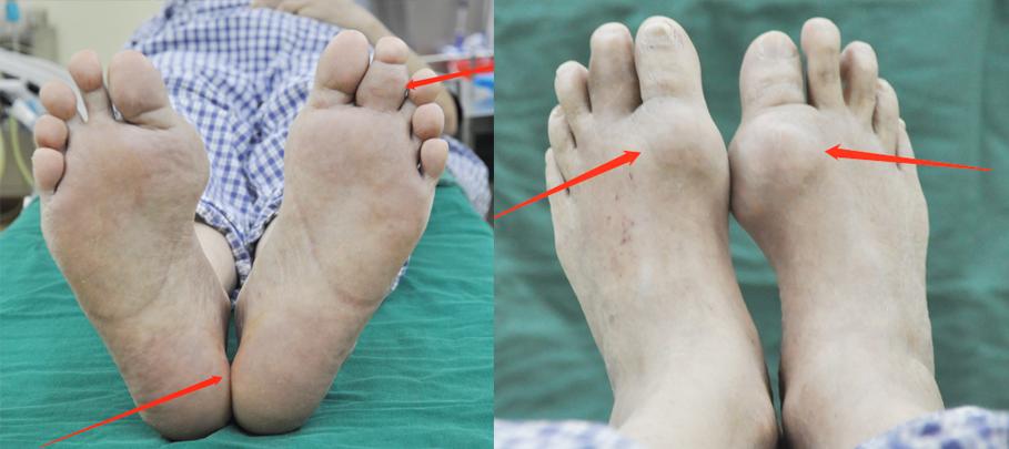 痛风脚踝有痛风石怎样才能变小,痛风石是引起痛风的根本原因吗