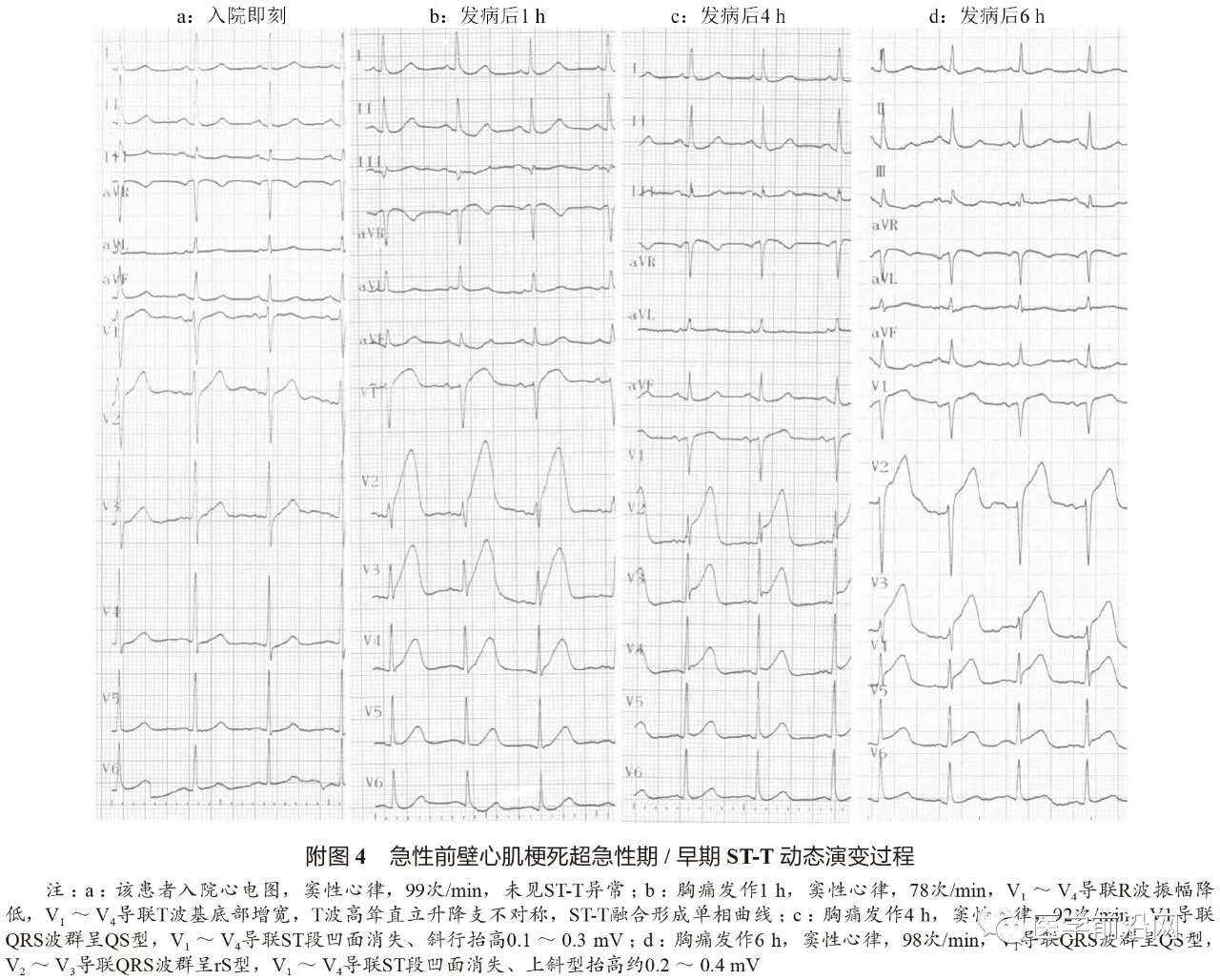 st抬高型心肌梗死溶栓时护理,急性st段抬高型心肌梗死治疗措施