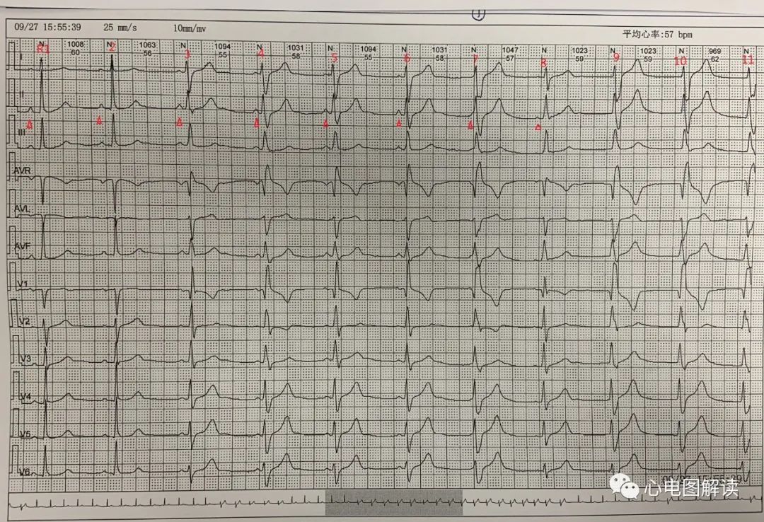 三度房室传导阻滞交界性逸搏,加速的室性逸搏心律的心电图表现