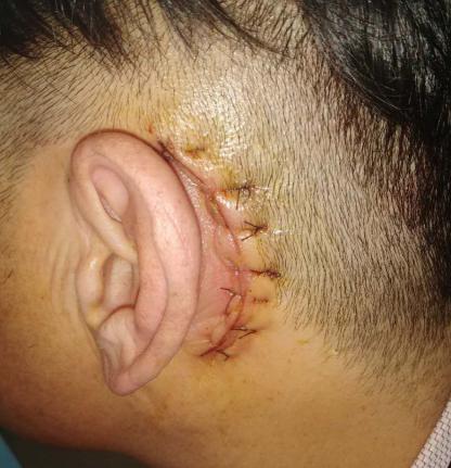 耳鼓膜修补手术方法有几种,爱耳日科普文章