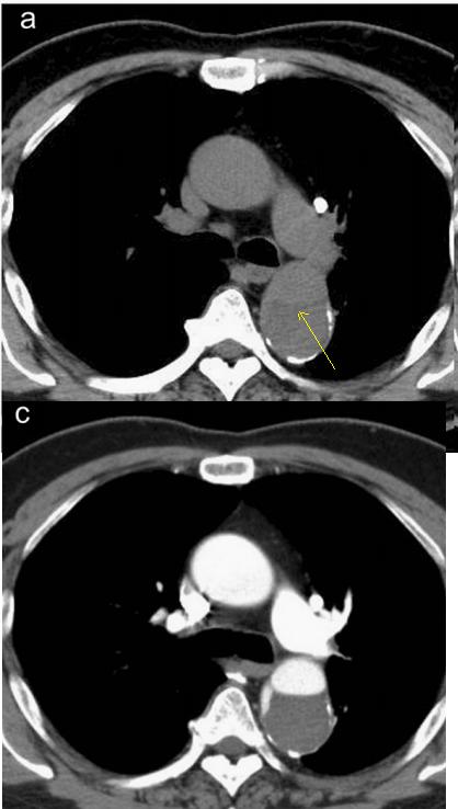 肠系膜上动脉夹层,心脏动脉夹层破裂