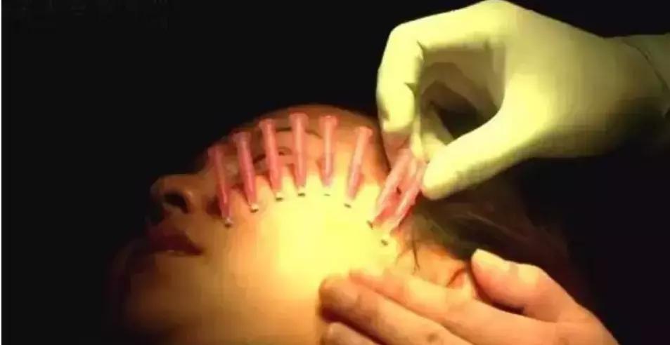 脸部蛋白线提拉紧致多久做一次,线雕蛋白线吸收后脸会怎么样