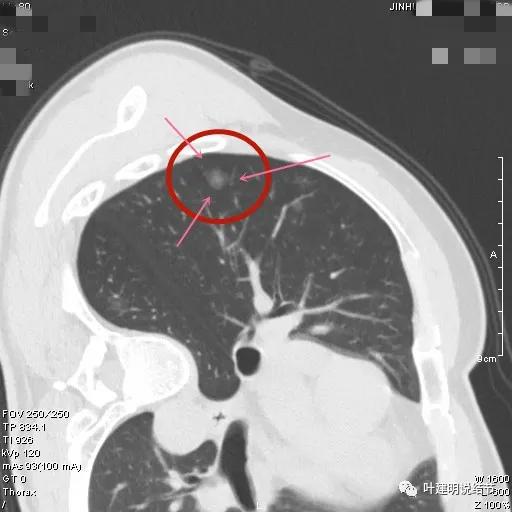 从活检怎么看是非小细胞癌,从病例谈辨证论治