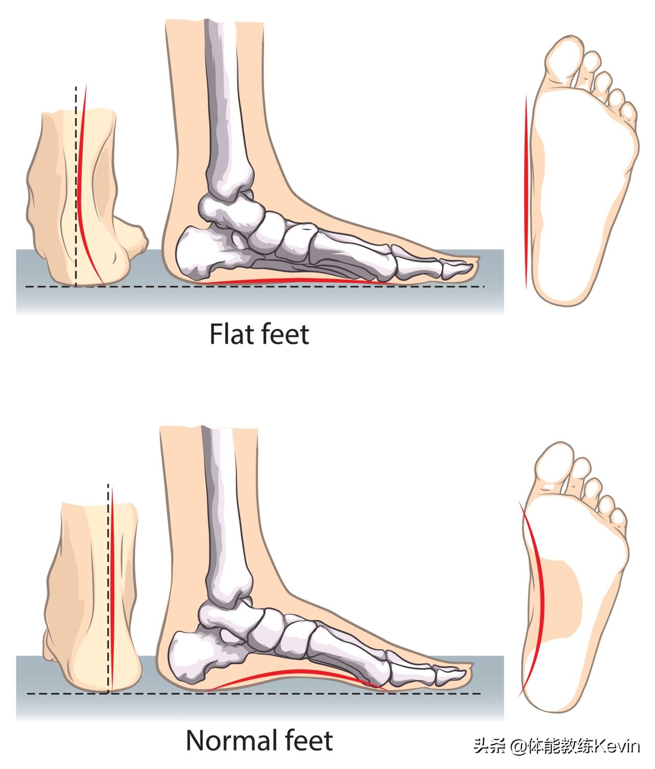 千里之行，始于“足下”——足外翻的5种解决方法