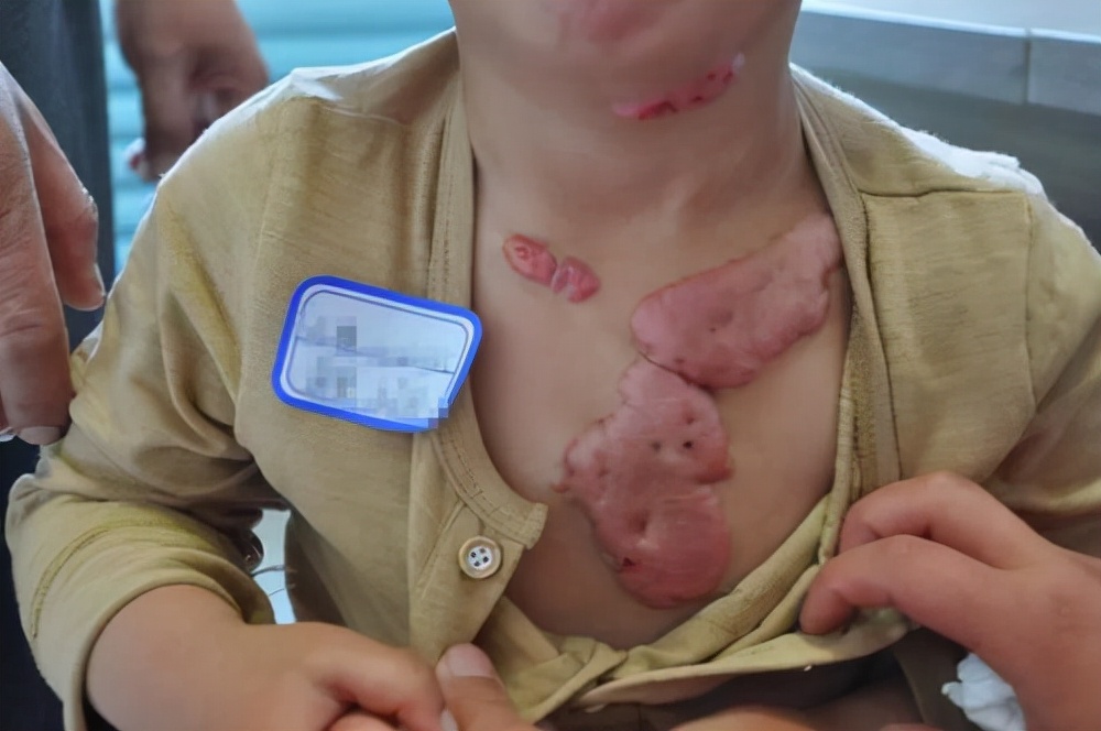 疤痕疙瘩越长越大怎么办,胸前疤痕疙瘩怎么能彻底消除