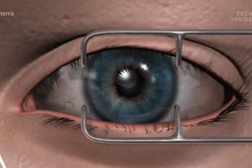 手术的时候医生对你做了什么,手术时切了一片肺叶