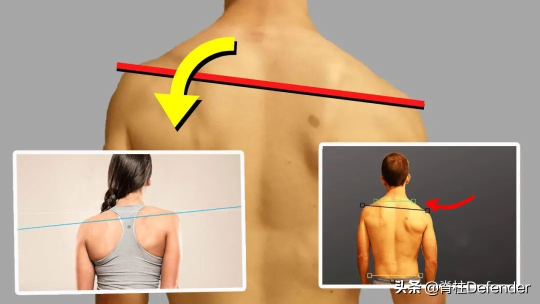 走路高低肩怎么矫正,高低肩怎么自我矫正
