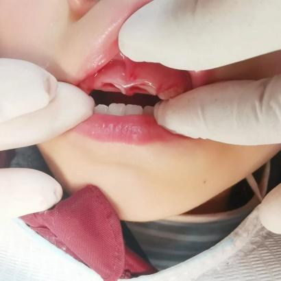 儿童把牙磕断了家长应如何处理,小孩牙齿摔松了要不要马上拔掉