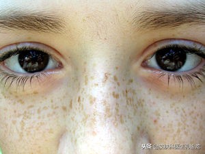 皮肤科常见疾病系列,雀斑属于什么皮肤病