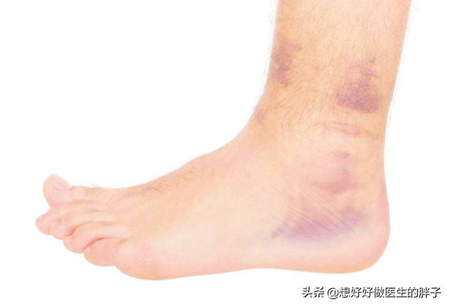 关于踝关节扭伤的正确处理方法,崴脚得重视