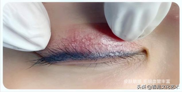 为什么纹美瞳线会露眼白,纹美瞳线第二天肿怎么快速消肿