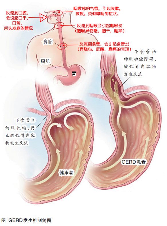 胃食管反流可以通过饮食逆转病情？医生：这样改变方式病才能好