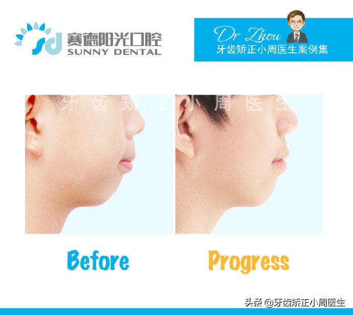 下巴后缩整容玻尿酸还是假体,如何不靠整容改变下巴