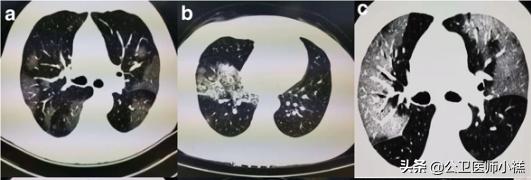 新型冠状病毒感染的肺炎患者肺部影像学改变