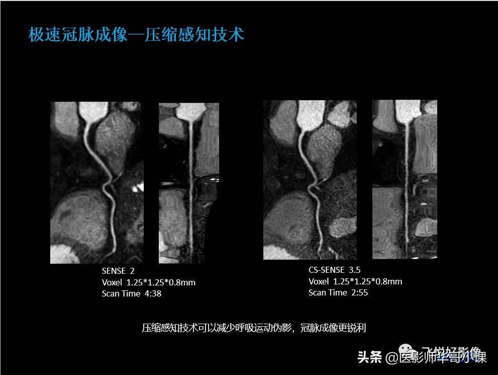飞利浦核磁共振快速扫描,飞利浦磁共振心脏扫描