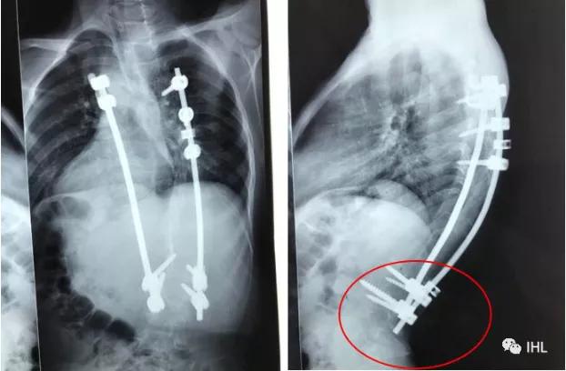 美国顶尖小儿骨科专家——DavidRoye教授已到我院工作