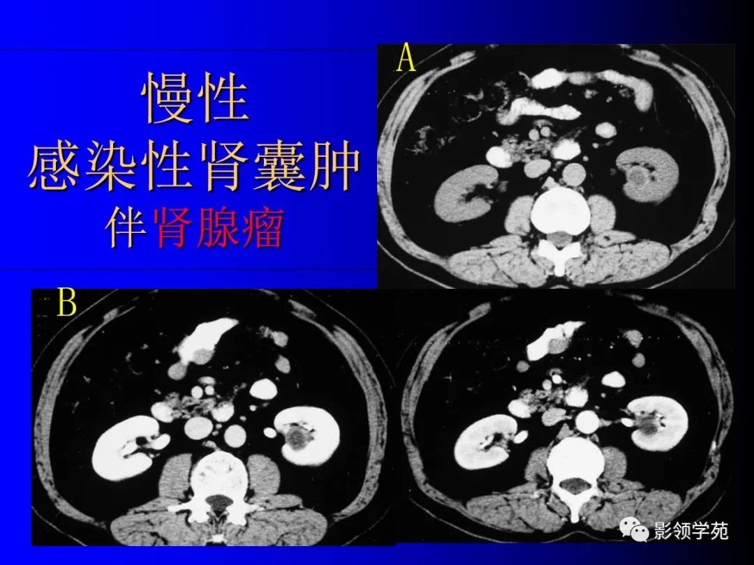 肾脏囊性肿块的影像学特点,肾脏典型病理图片及解析