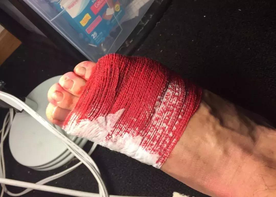 中国留学生被截肢,励志留学生