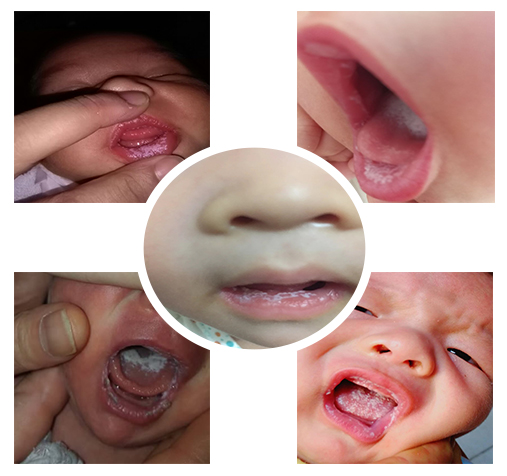 鹅口疮用了很多方法，反反复复怎么办？