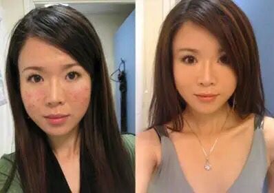 19岁姑娘打溶脂针,女子打美容针脸肿