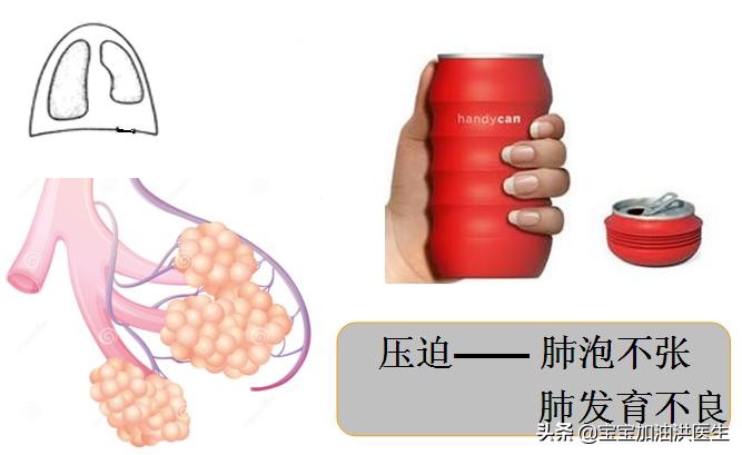 #洪医生看出生缺陷#-胎儿胸腔积液