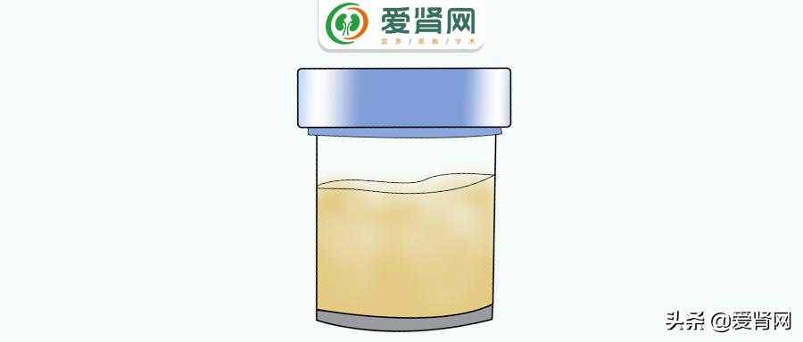老人尿蛋白3+是怎么回事,孕晚期尿蛋白3+什么原因