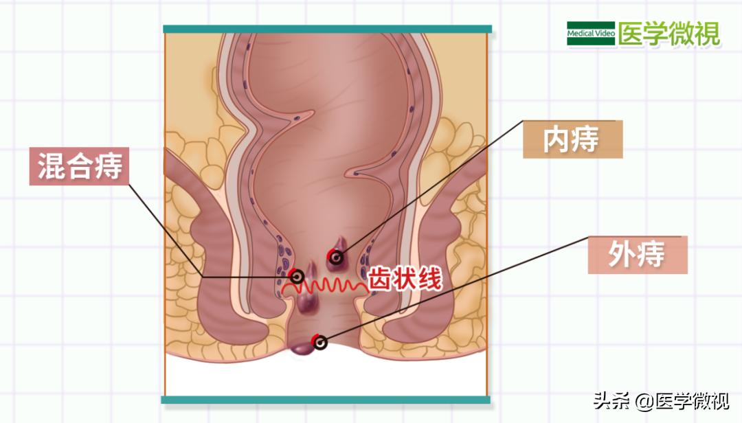 痔疮治疗原则,痔疮二十四种最佳治疗方法