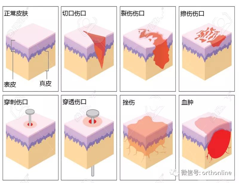 临床清创原则,临床清创