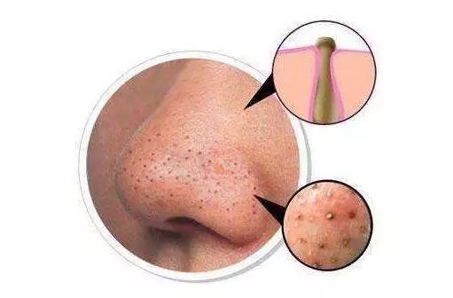 脸上长白色米粒痘痘怎么快速消除,脸上痘痘里面白色米粒是什么东西