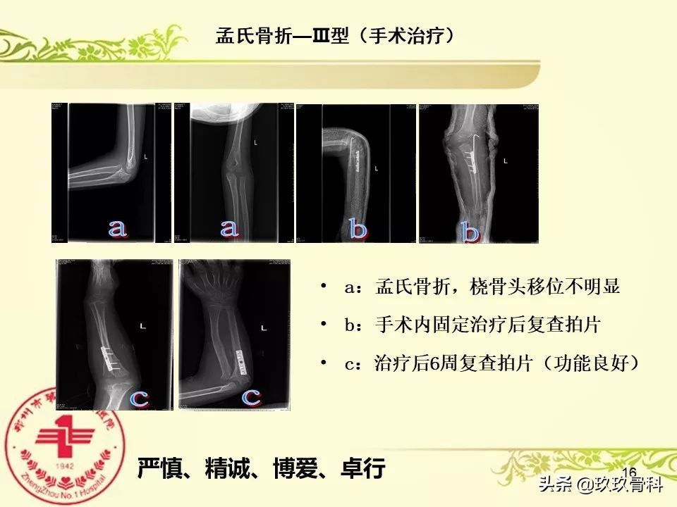 孟氏骨折功能训练多久能恢复正常,孟氏骨折中医能治吗