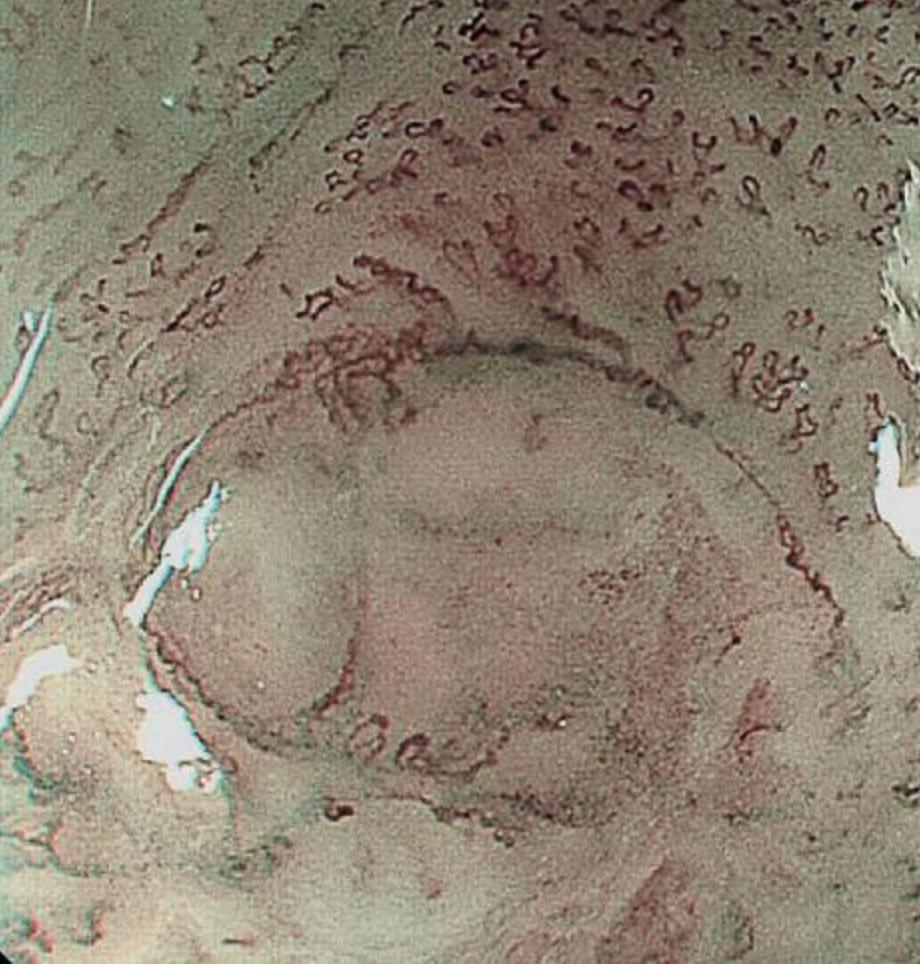 食管癌早期做胃镜能查到吗,食管癌通过胃镜可以检查出来吗