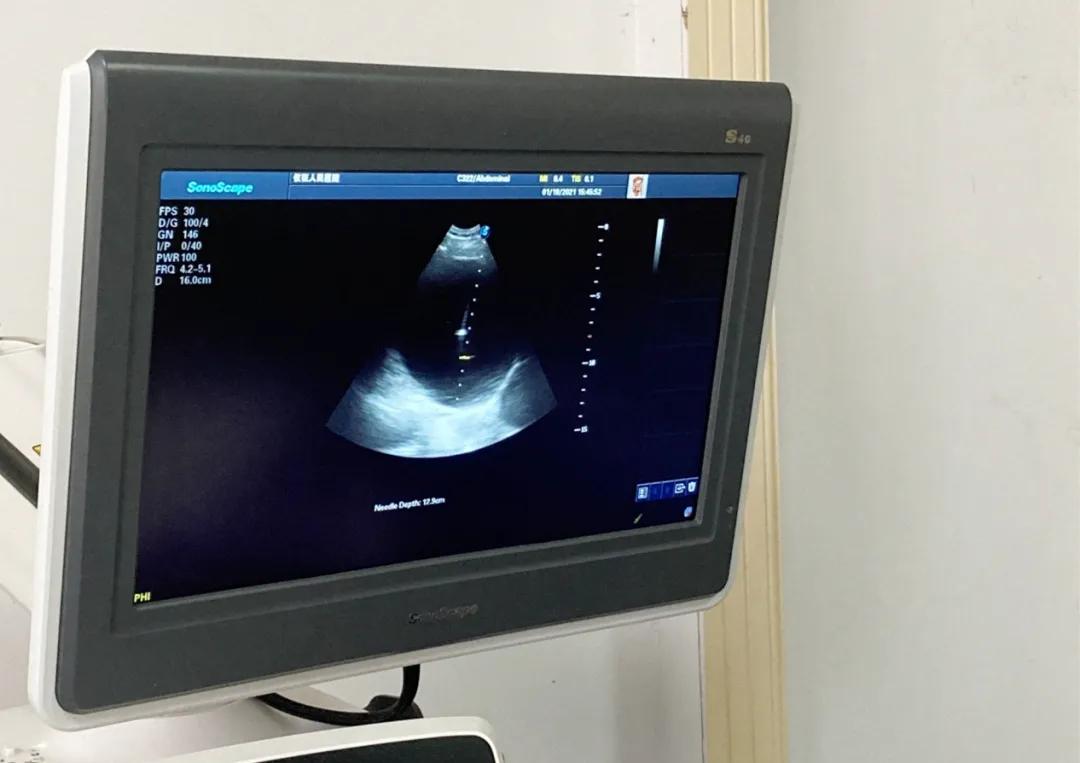 巨大肝囊肿怎么办,肝囊肿大了怎样做微创术