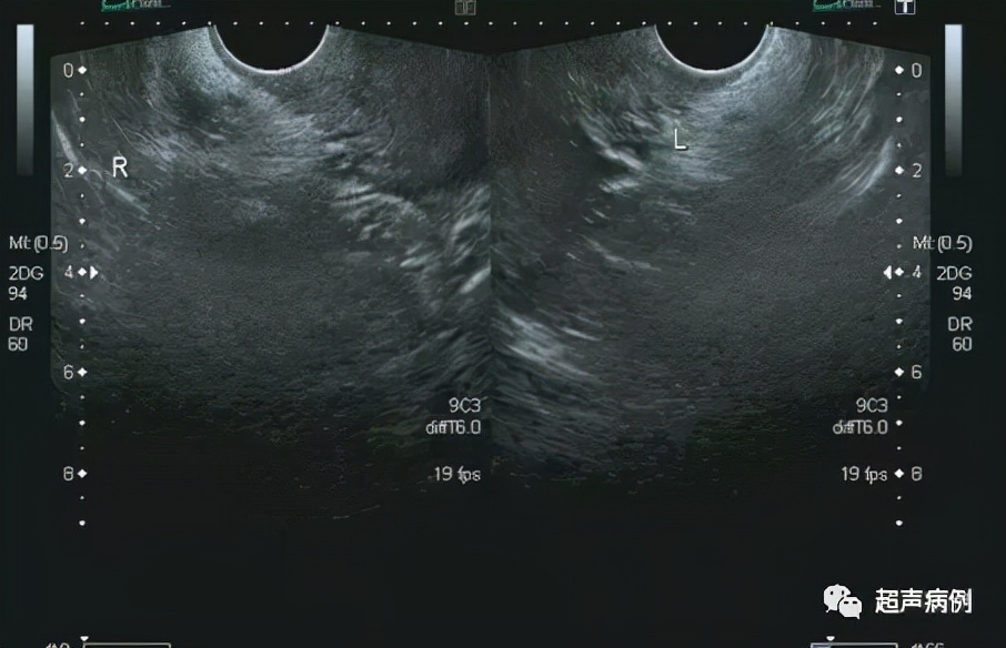 臀部疼痛就诊，超声意外发现这样盆腔包块
