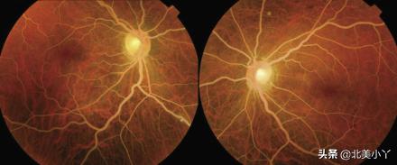 王医生谈血脂高怎么办,血脂防治小贴士