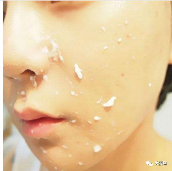 牙膏真的可以去粉刺吗,牙膏对鼻子黑头有什么作用