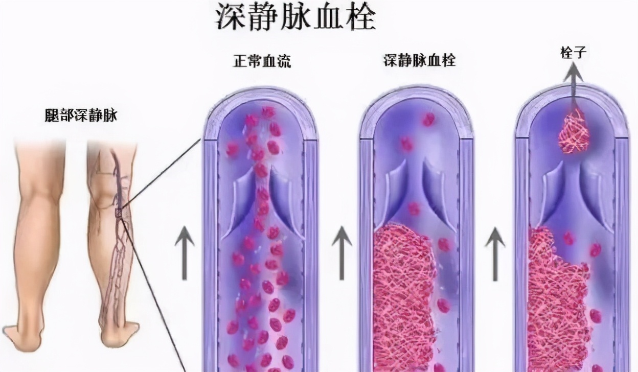 动脉血管堵用什么药,动脉和静脉血管堵哪个严重些