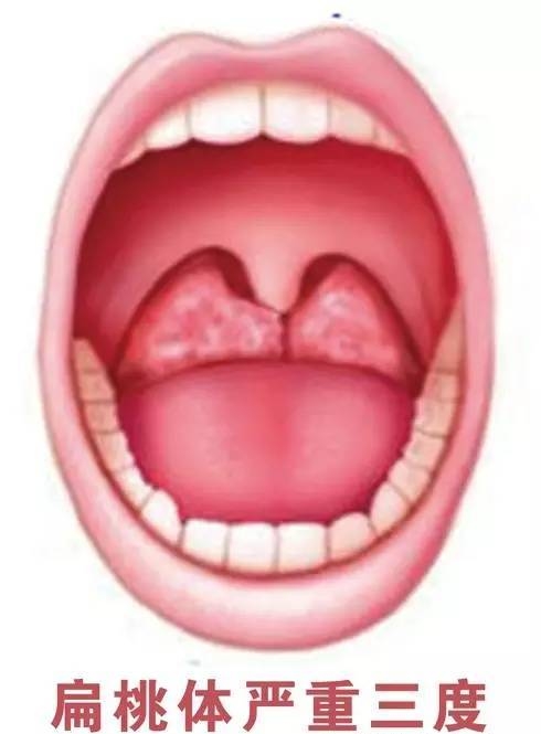 急性扁桃体炎引起的耳痛,急性扁桃体炎怎么缓解疼痛