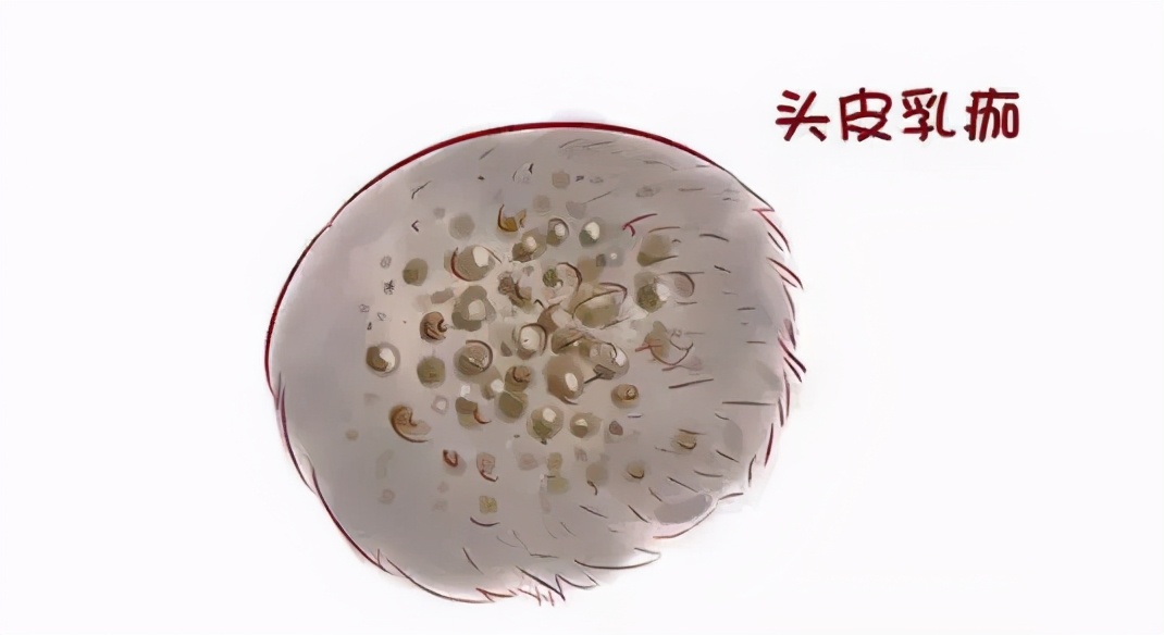4个月宝宝头皮乳痂反复起怎么办,婴儿头皮乳痂能去除吗