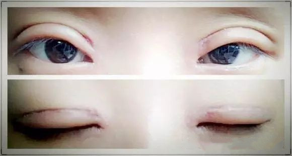 怎样修复双眼皮线条,上海修复肉条双眼皮哪里做的好