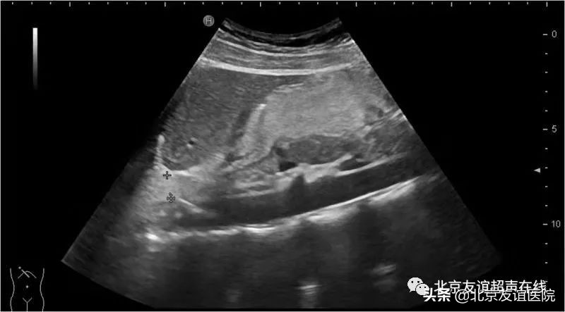 中医治疗胃食管反流病靠谱吗,胃食管反流病北京医院