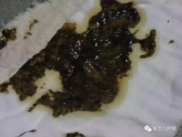 新手爸妈｜奶瓣、绿便、腹泻、便秘……宝宝各种便便真图全解必备
