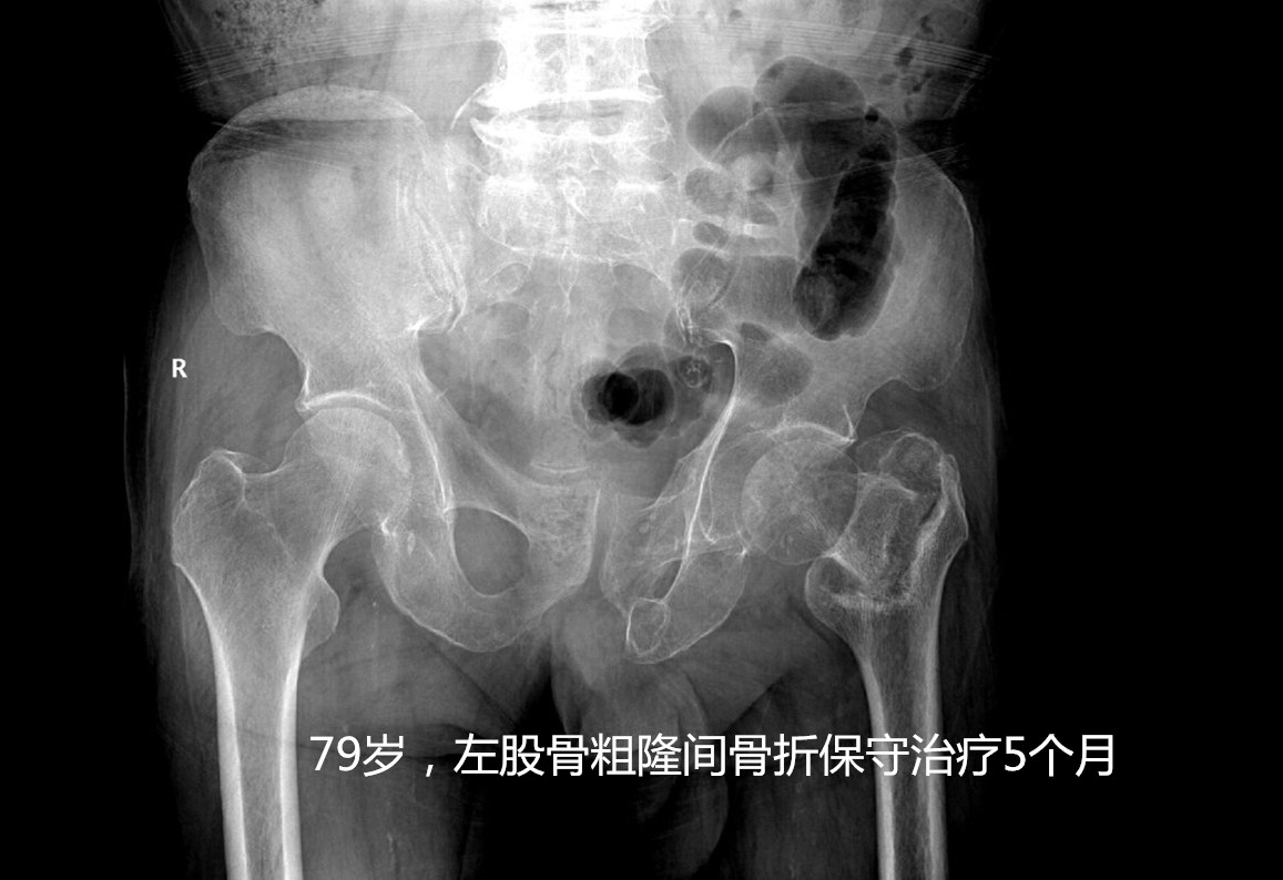 人生最后一次骨折有必要手术吗,人生的最后一次骨折指哪个部位